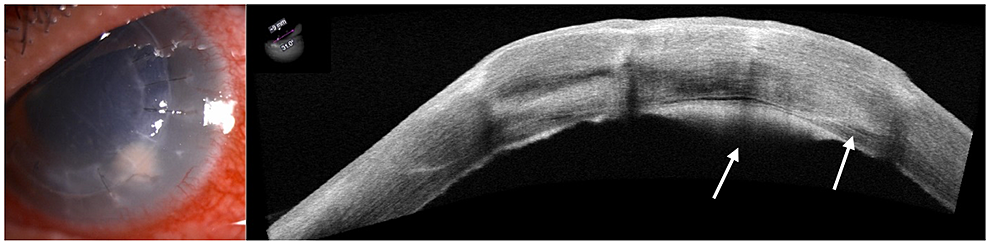 Endothelial-plaque-with-dense-infiltrate-involving-graft-host-interface-(arrow),-with-intact-epithelium.
