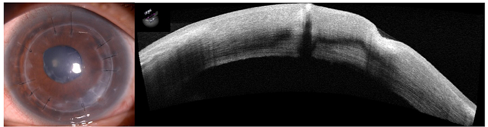 After-six-weeks-of-treatment,-the-infiltrate-resolved-with-scarring-and-graft-thinning.