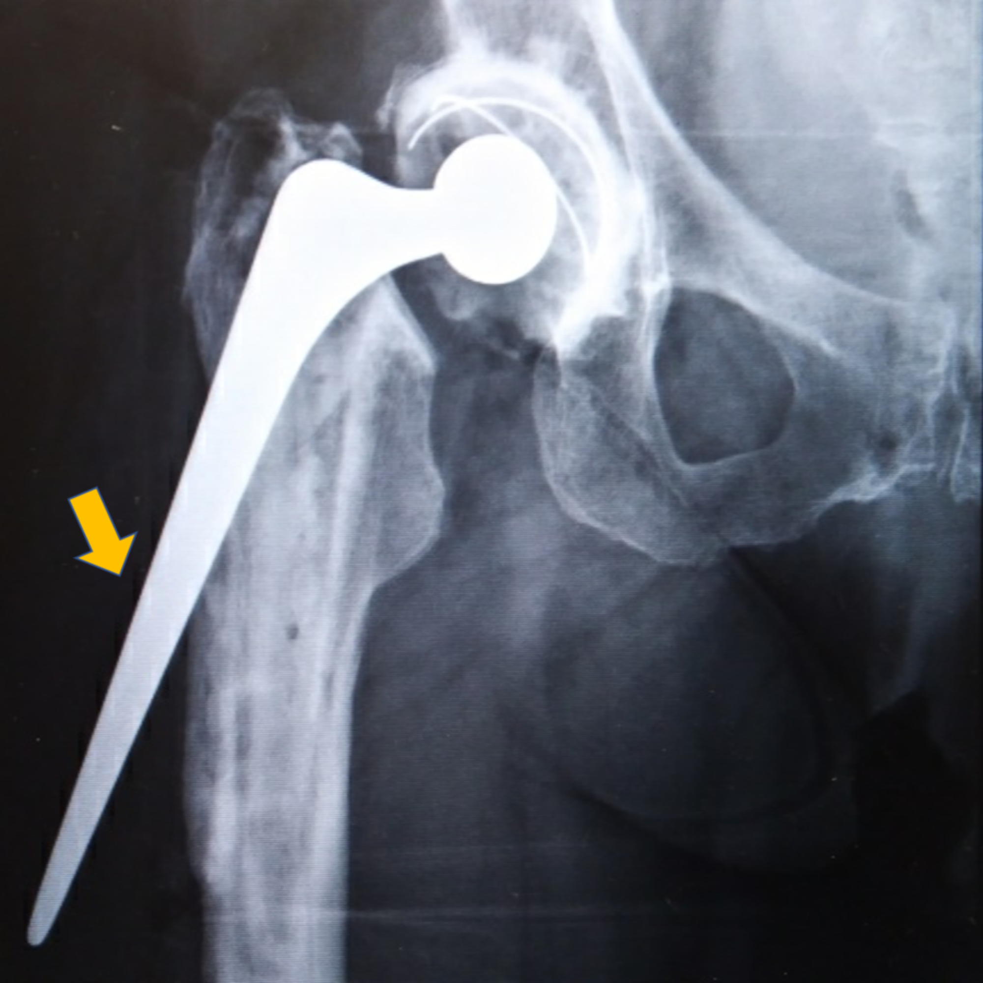 a fractured hip