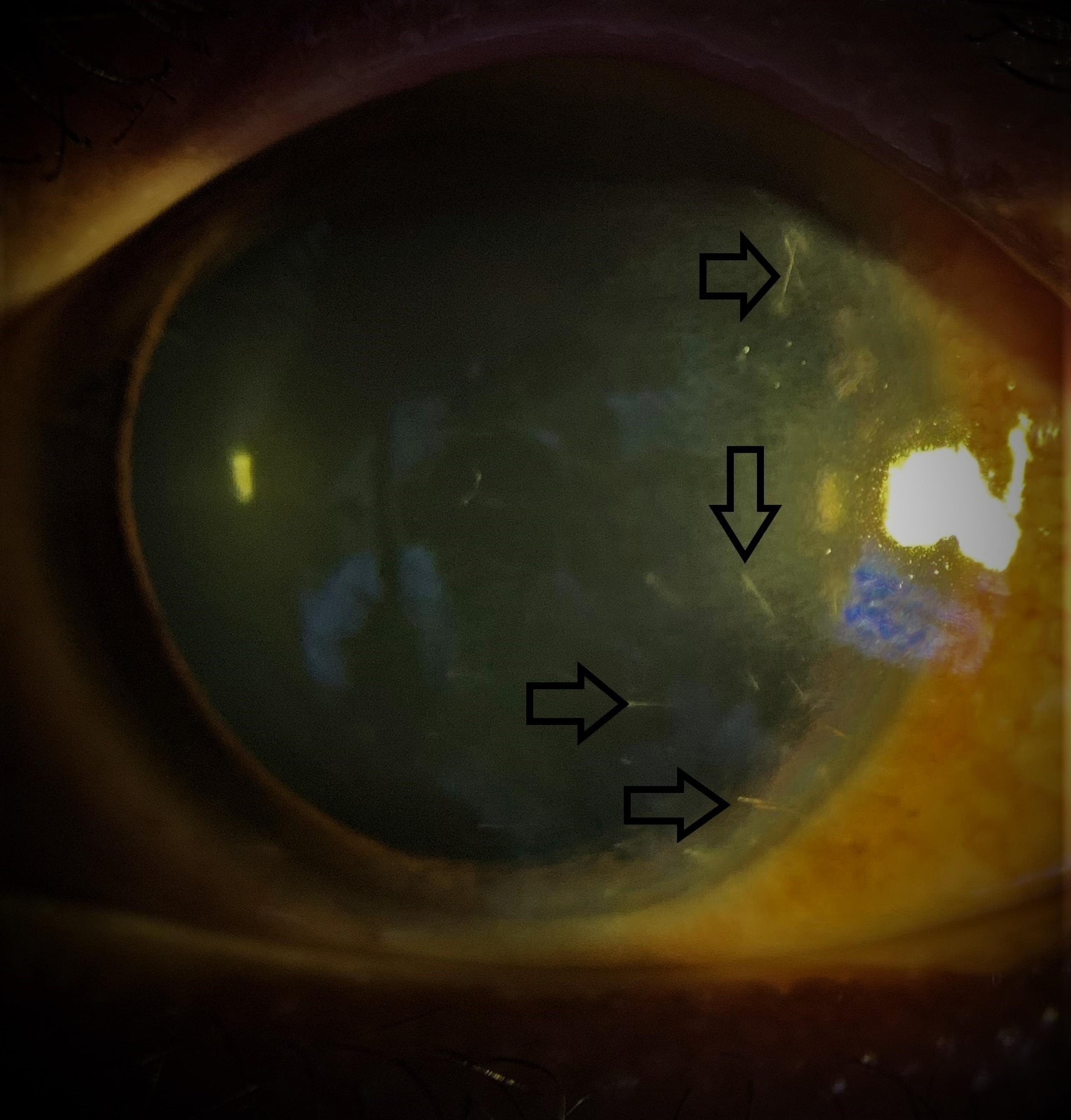 Cureus | Ocular Injuries Due to Insect Spines (Ophthalmia Nodosa):  Potential Hazard to Motorcyclists
