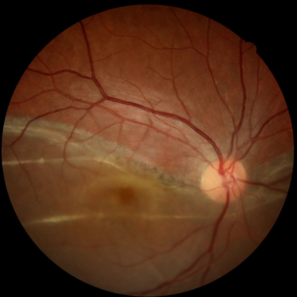 Inferior-retinal-detachment-in-the-right-eye-
