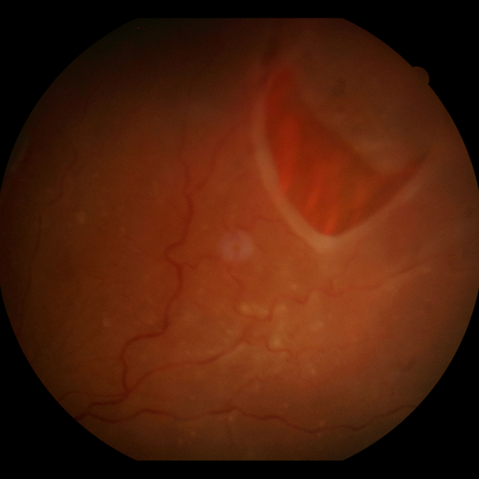 Total-retinal-detachment-in-the-right-eye-