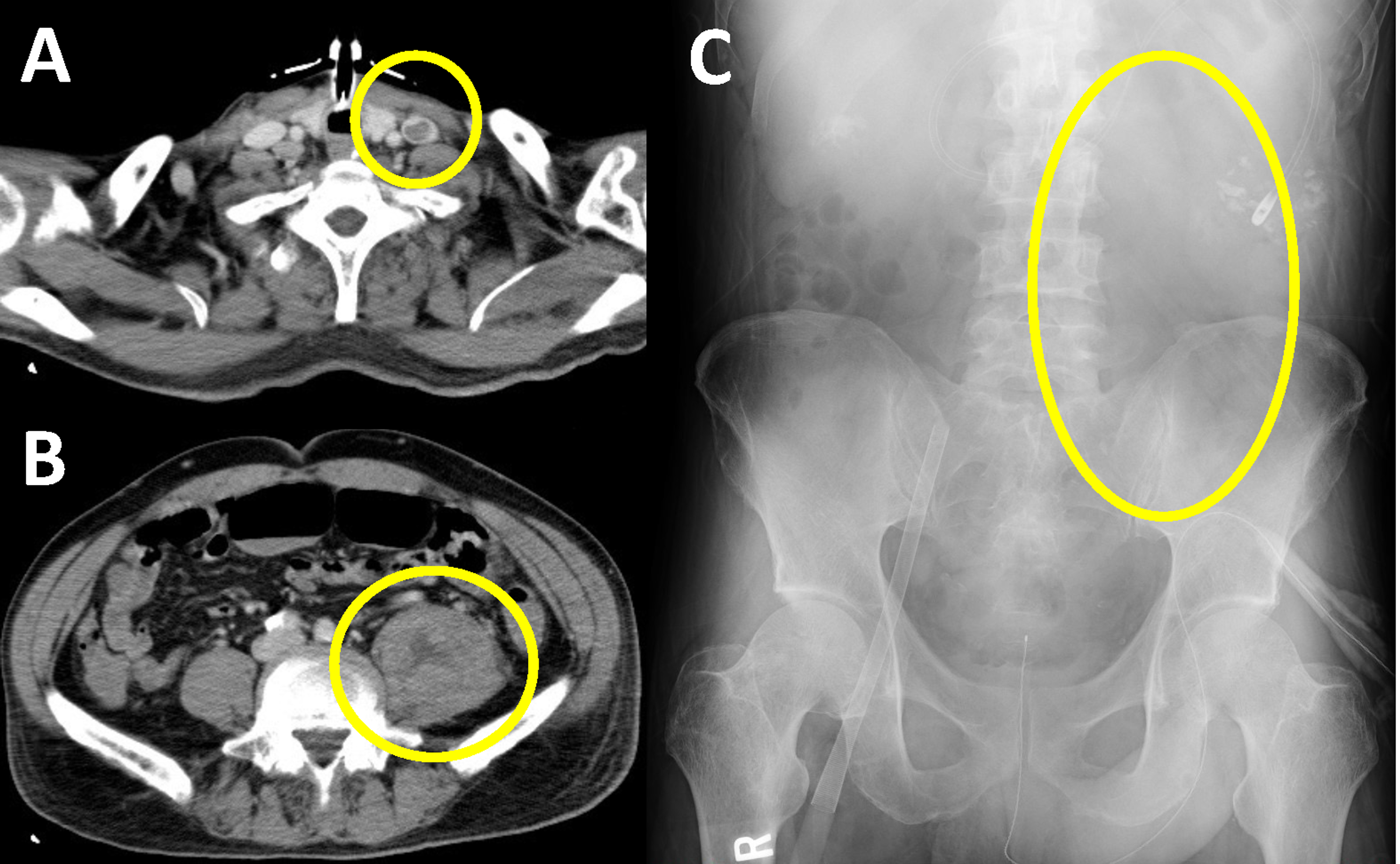 psoas sign x ray