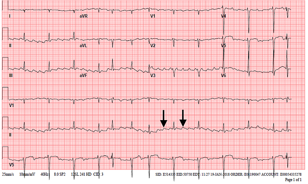 Atrial Flutter Litfl Ecg Library Diagnosis