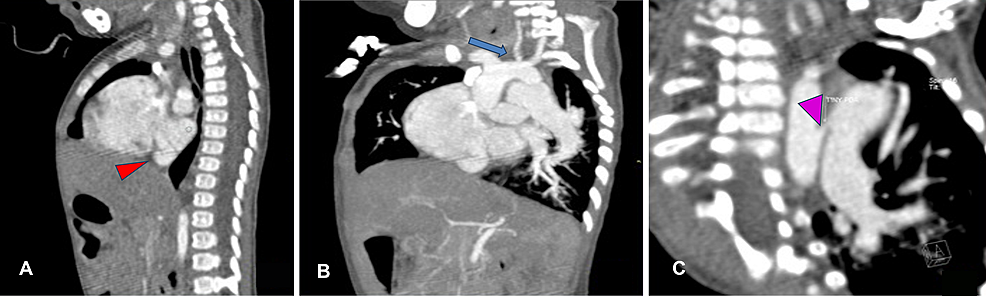 Contrast-cardiac-CT-scan-(sagittal-and-coronal-view)-of-the-11-month-old-boy