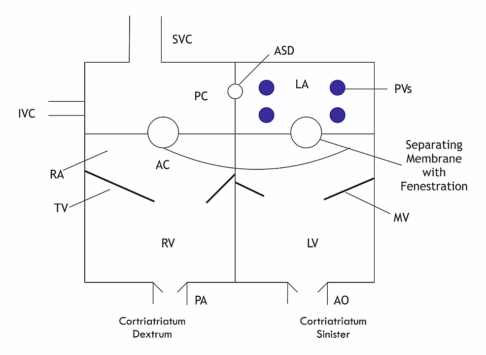 Diagram-of-cor-triatriatum-sinistrum-and-dextrum-anatomy
