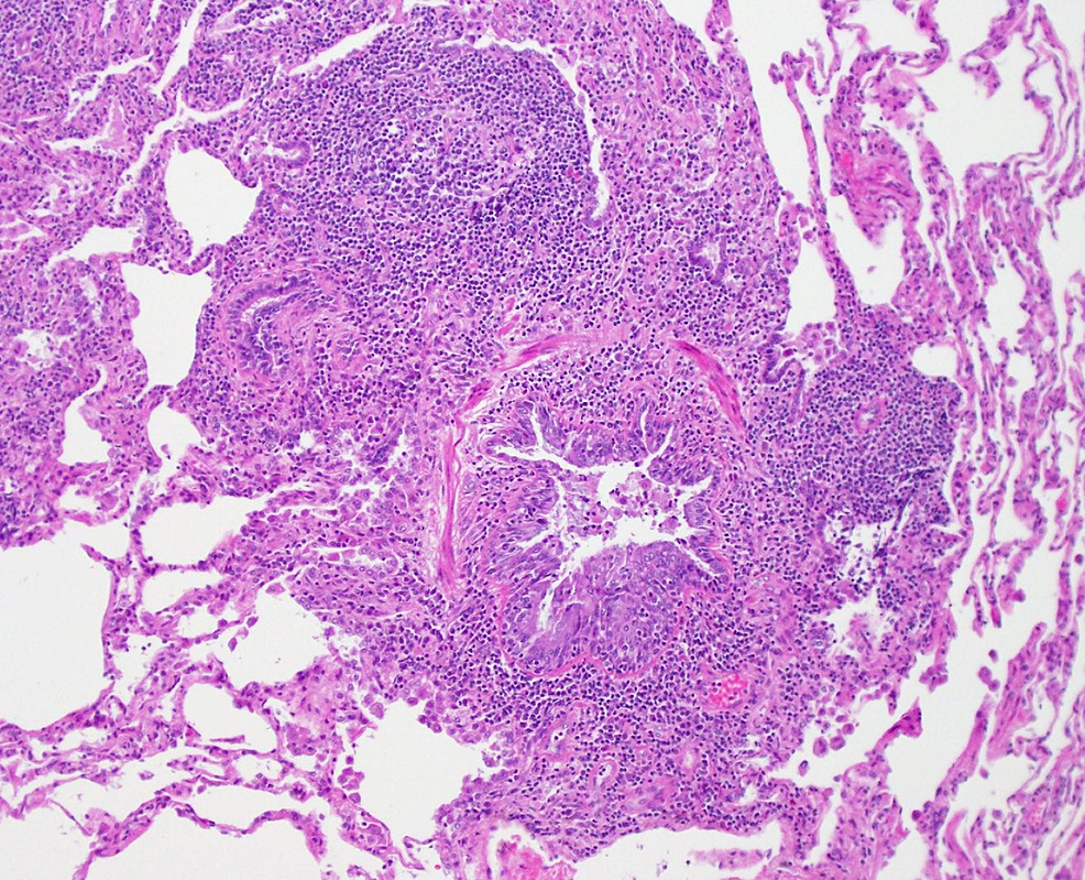 Hematoxylin-and-eosin-(H&amp;E)-stain-from-surgical-lung-biopsy-showing-airway-narrowing-with-enlarged-peribronchiolar-lymphoid-follicles,-consistent-with-follicular-bronchiolitis.