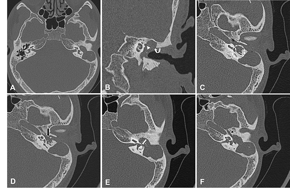 Cureus Temporal Bone Cholesteatoma Typical Findings and Evaluation of Diagnostic Utility on