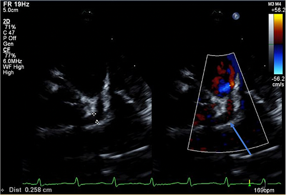 Transthoracic-echocardiogram-obtained-on-day-10-of-illness-showing-a-significantly-dilated-left-main-coronary-artery-(LMCA)-(Z-score-=-3.4)-(blue-arrow)