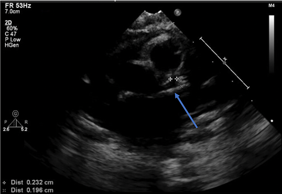 Transthoracic-echocardiogram-obtained-at-three-months-of-illness-showing-resolution-of-left-main-coronary-artery-dilatation-(blue-arrow);-left-coronary-artery-ostium-marked-with-plus-markers.