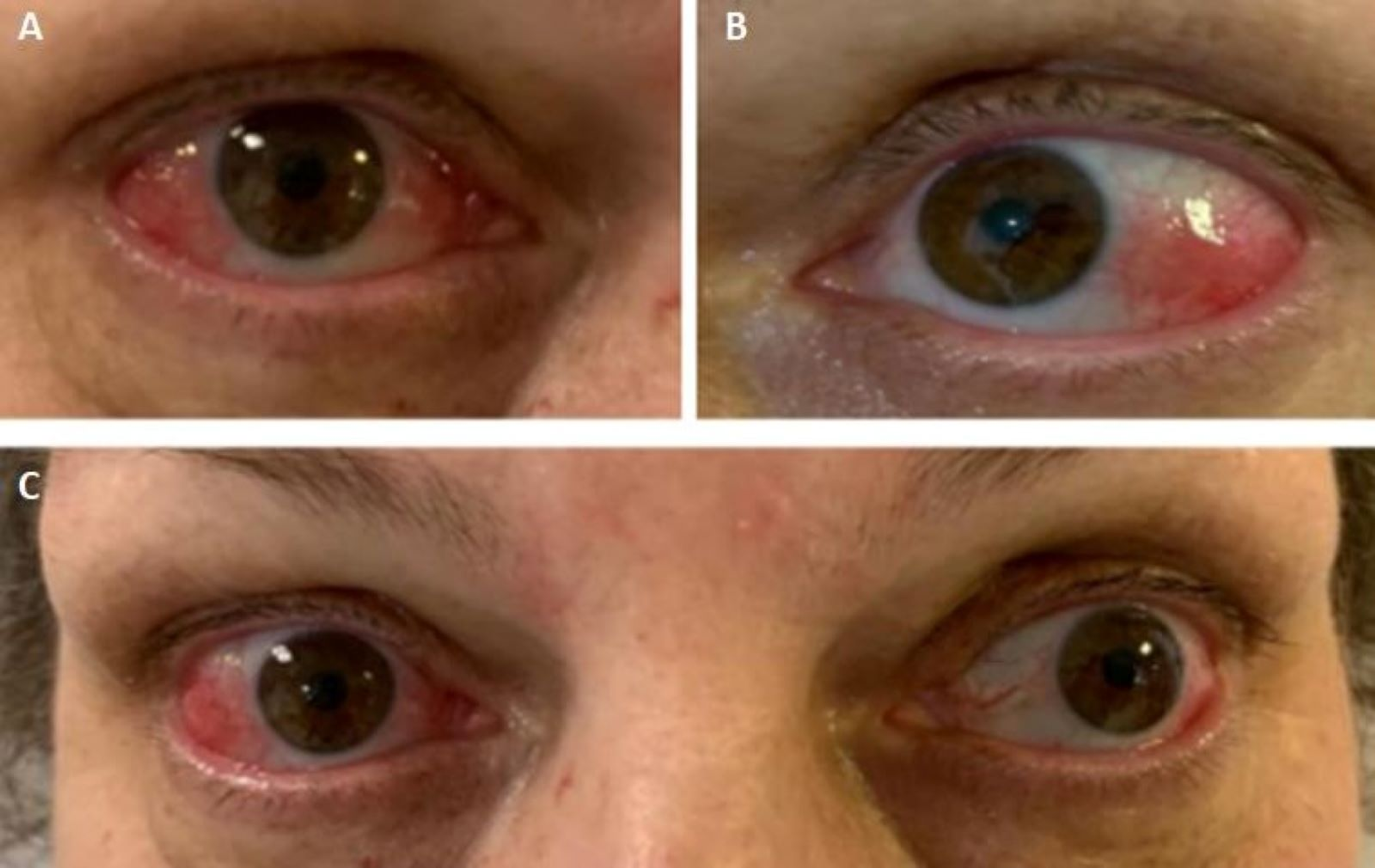 Cureus Sweet's Syndrome A Case Report of a Rare Extraintestinal