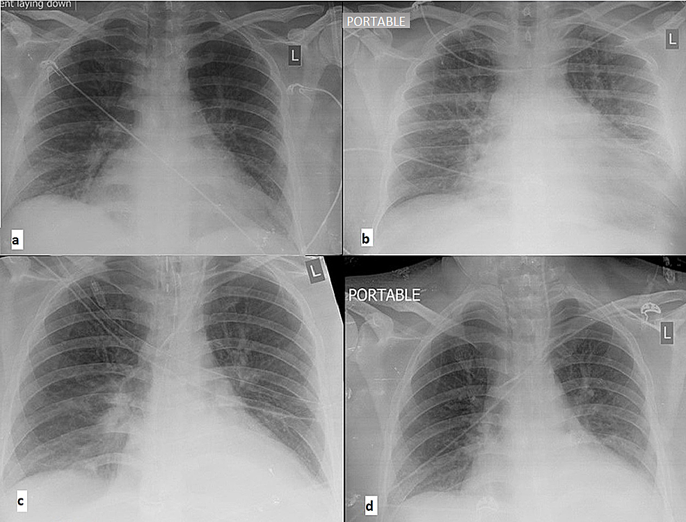 Cureus | Severe Multisystem Inflammatory Syndrome Associated With SARS ...