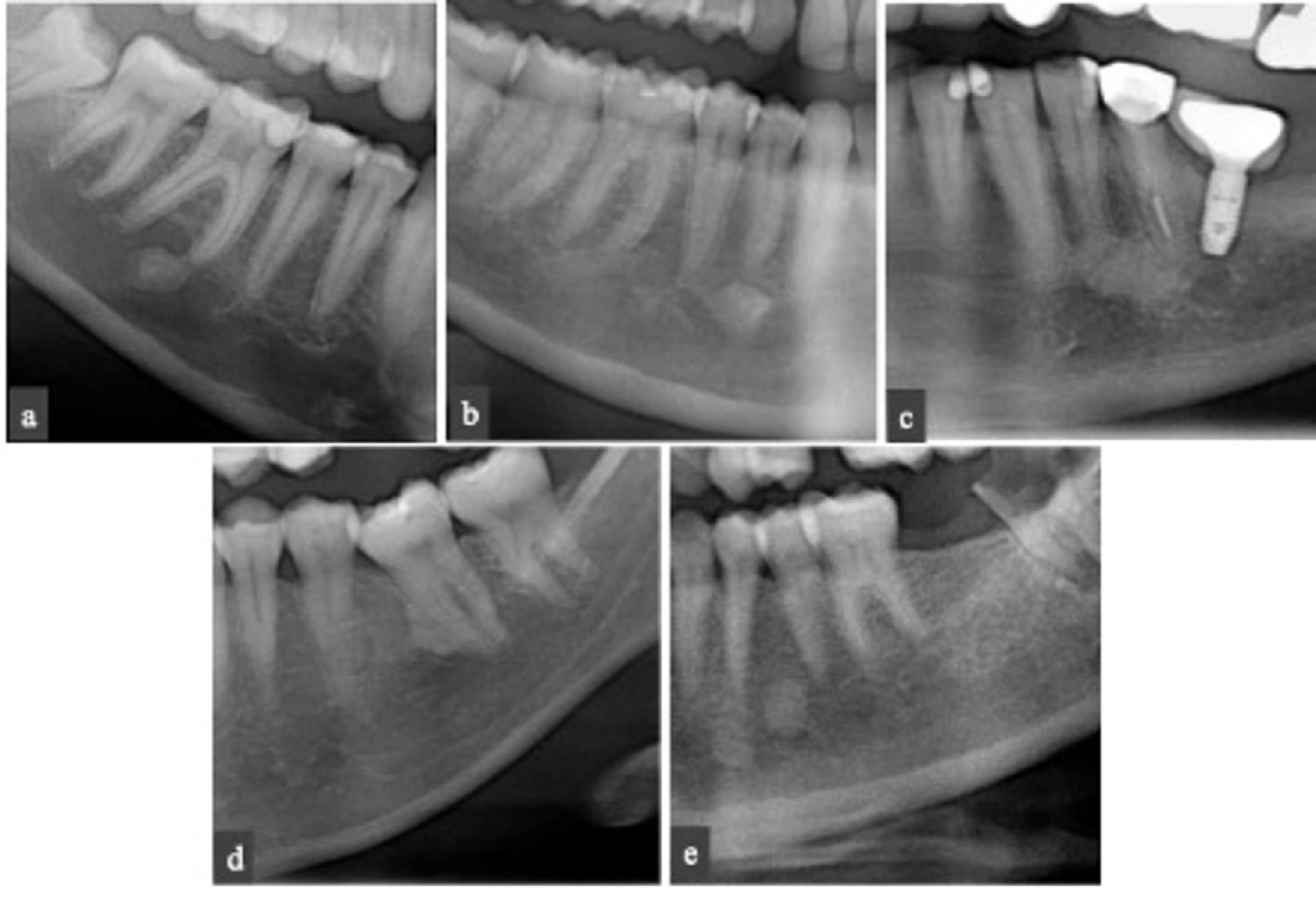 Cureus Prevalence and Pattern of Idiopathic Osteosclerosis and