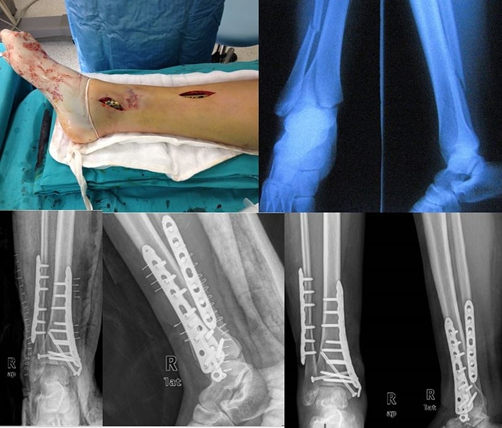 Minimally Invasive Treatment of Ankle Fractures in Patients at