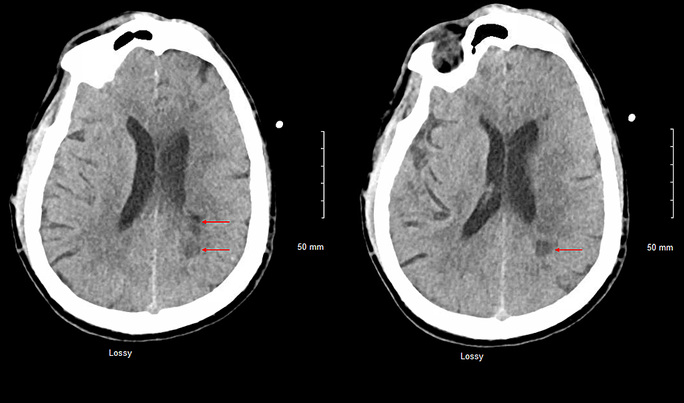 CT-head-axial-view-plain-revealed-multiple-white-matter-hypodensities-concerning-septic-emboli-(Red-arrows).