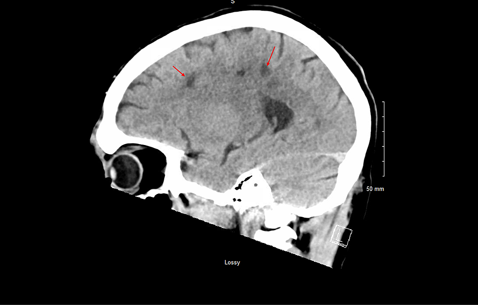 CT-head-sagittal-view-plain-revealed-multiple-white-matter-hypodensities-concerning-septic-emboli-(Red-arrows).