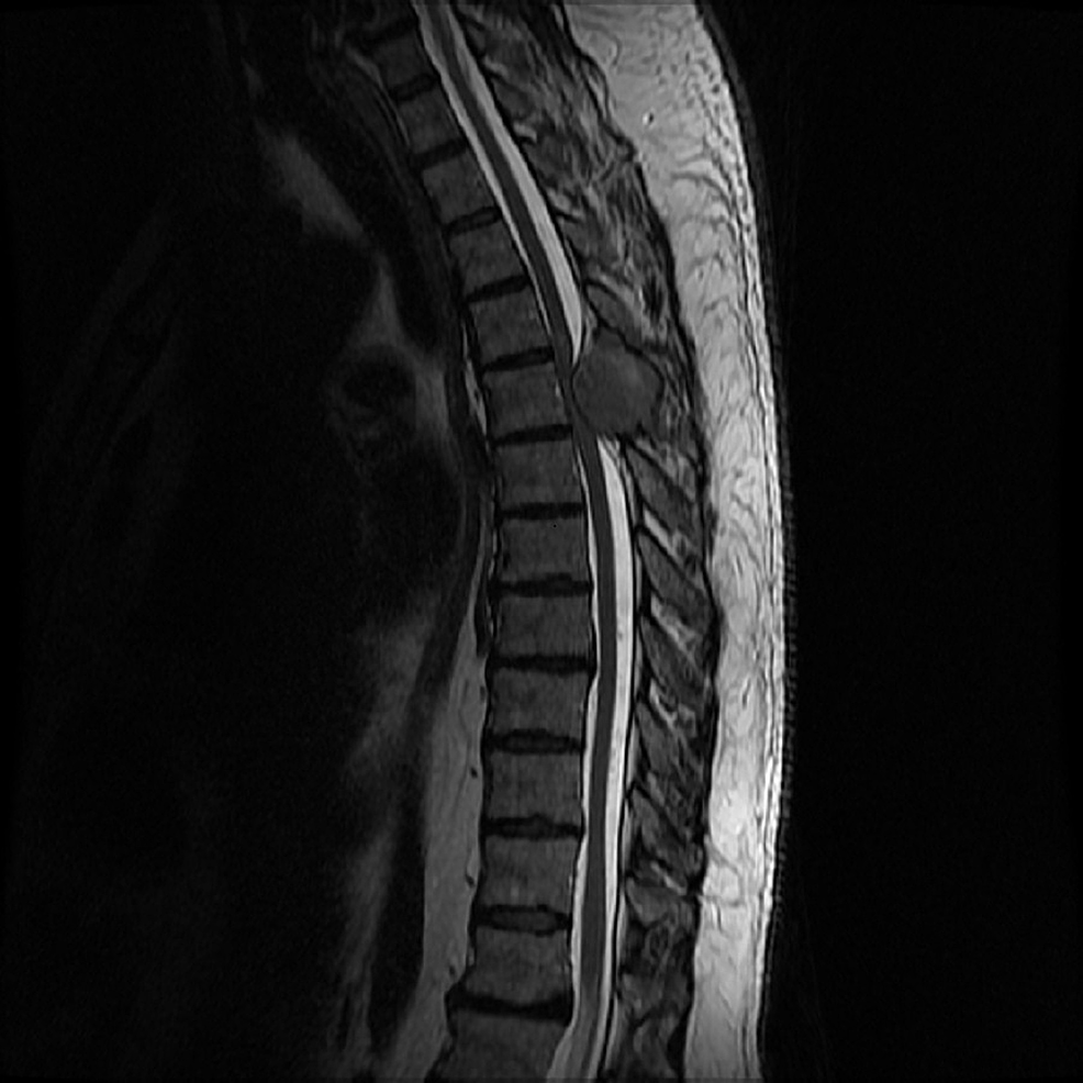 Cureus Isolated Spinal Metastasis with Spinal Cord Compression Leads
