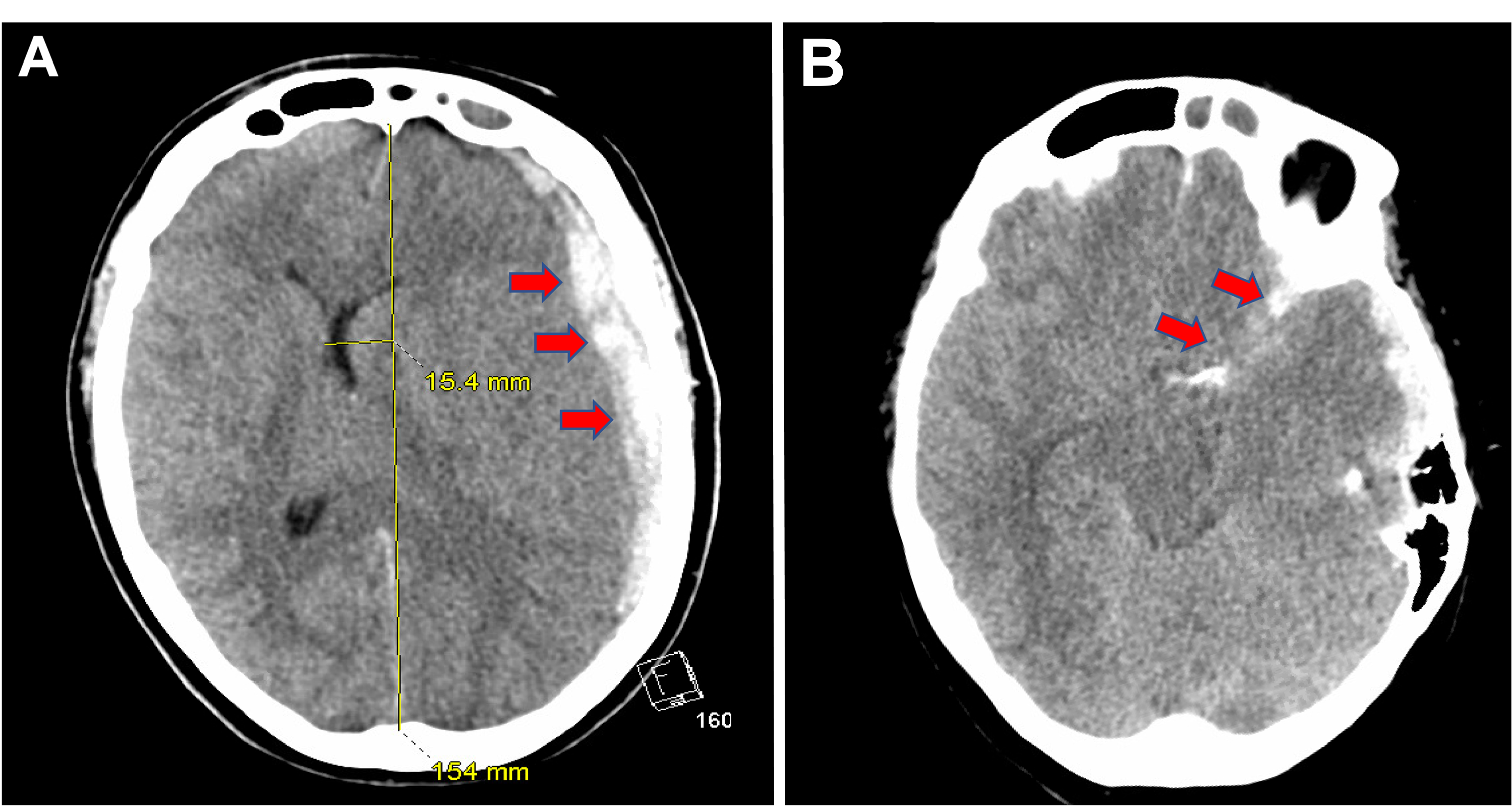 cerebral aneurysm ct