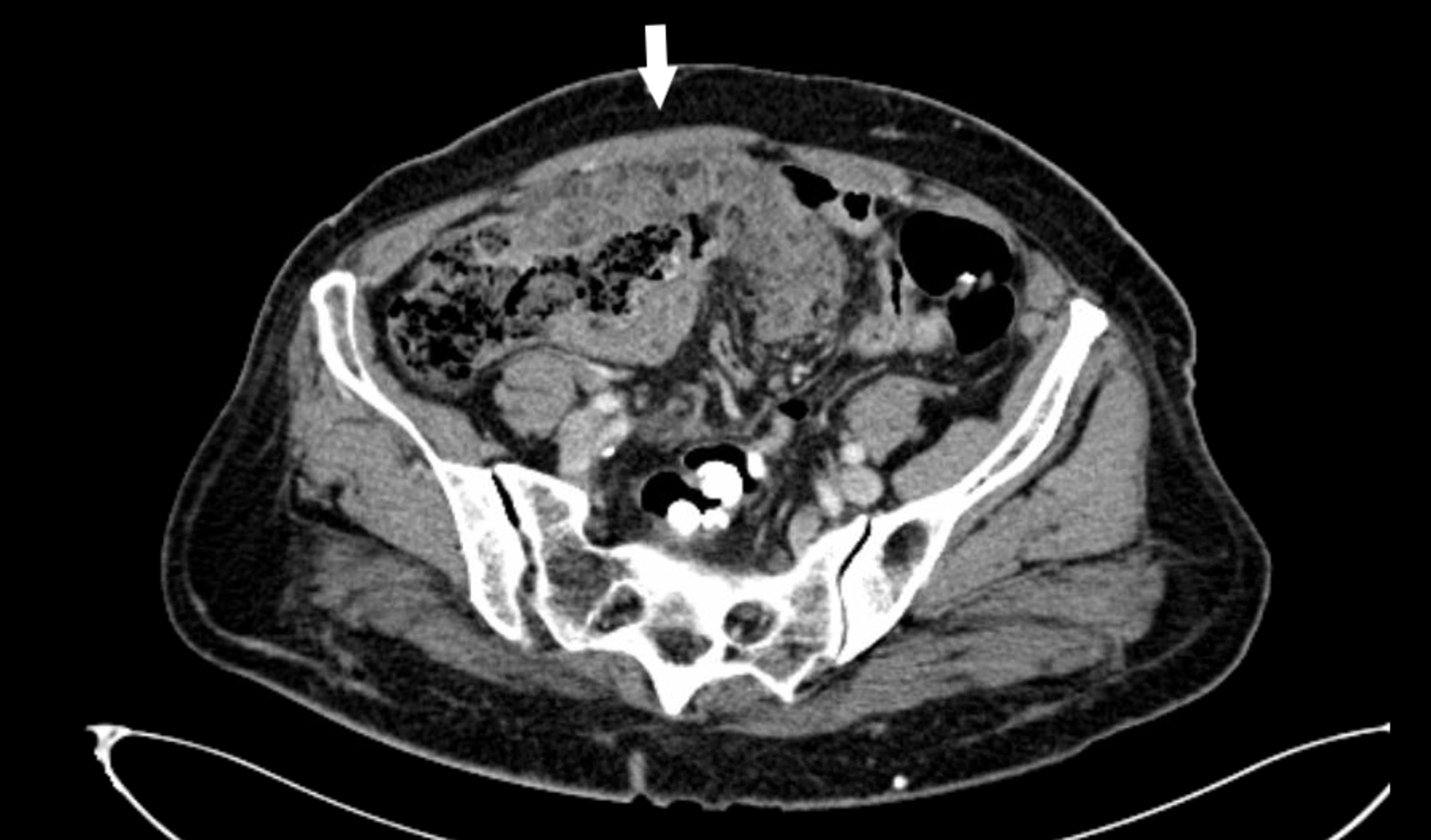 Cureus Metastatic Mucinous Adenocarcinoma of Gastrointestinal Origin