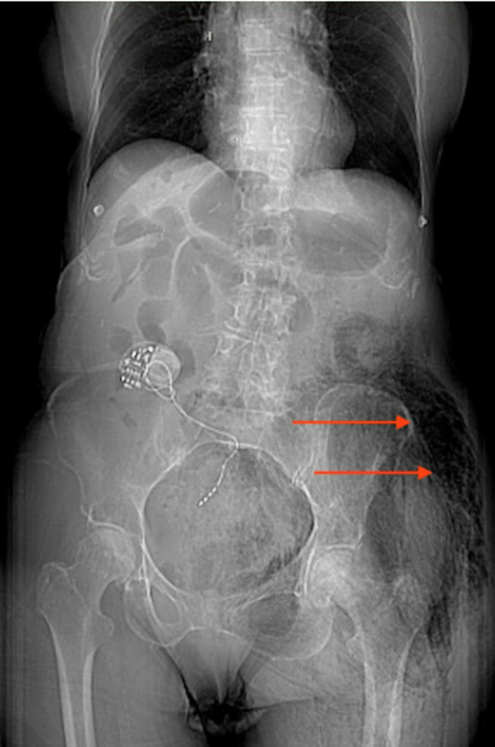 Tomodensitométrie-(CT)-abdomen-et-bassin-avec-contraste-antéropostérieur-vue-montrant-de-l’air-libre-dans-les-régions-fessières-et-hanches-gauche-(flèches rouges)