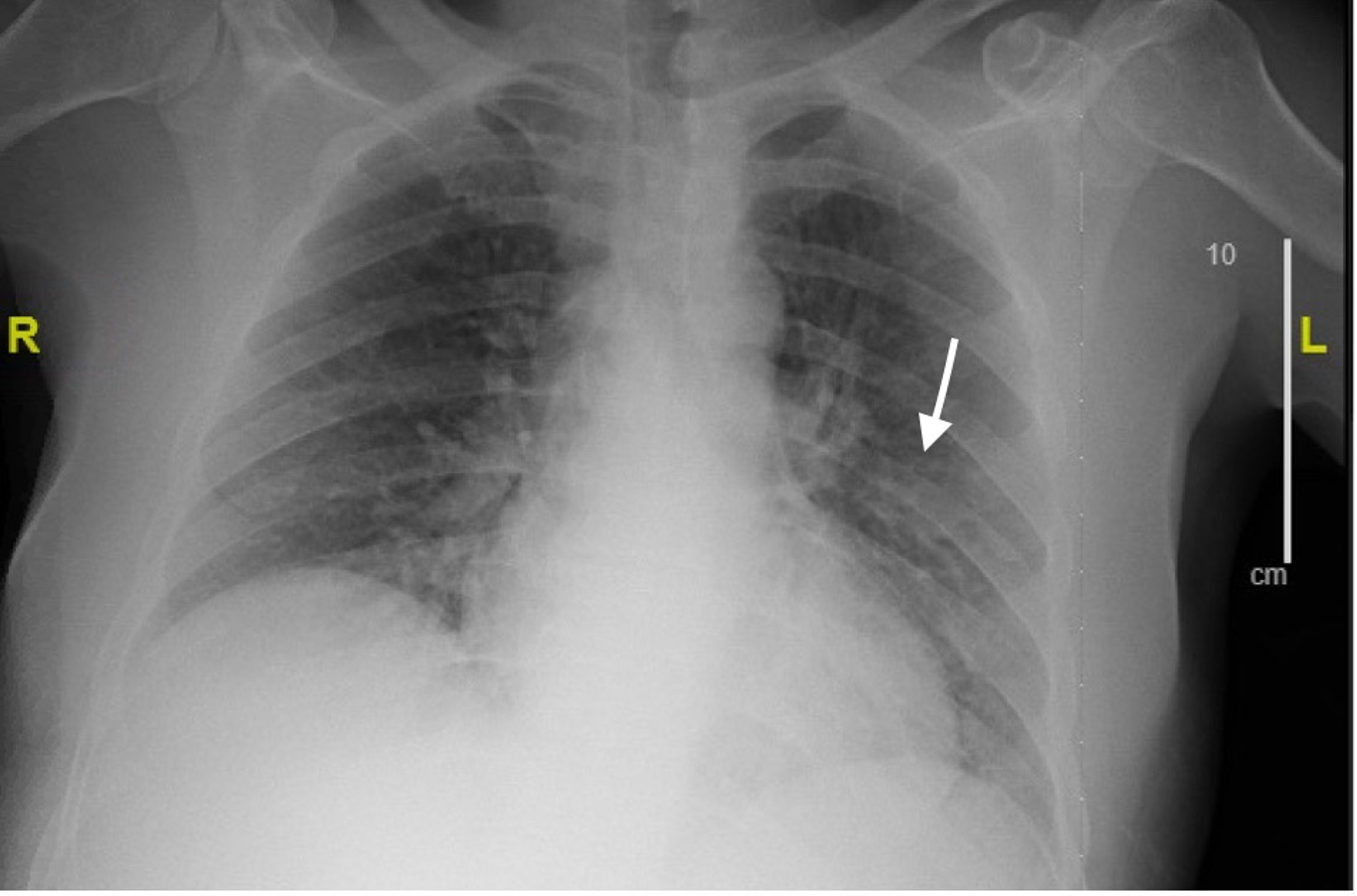 Cureus | A Rare Presentation of Infective Endocarditis Due to Serratia ...