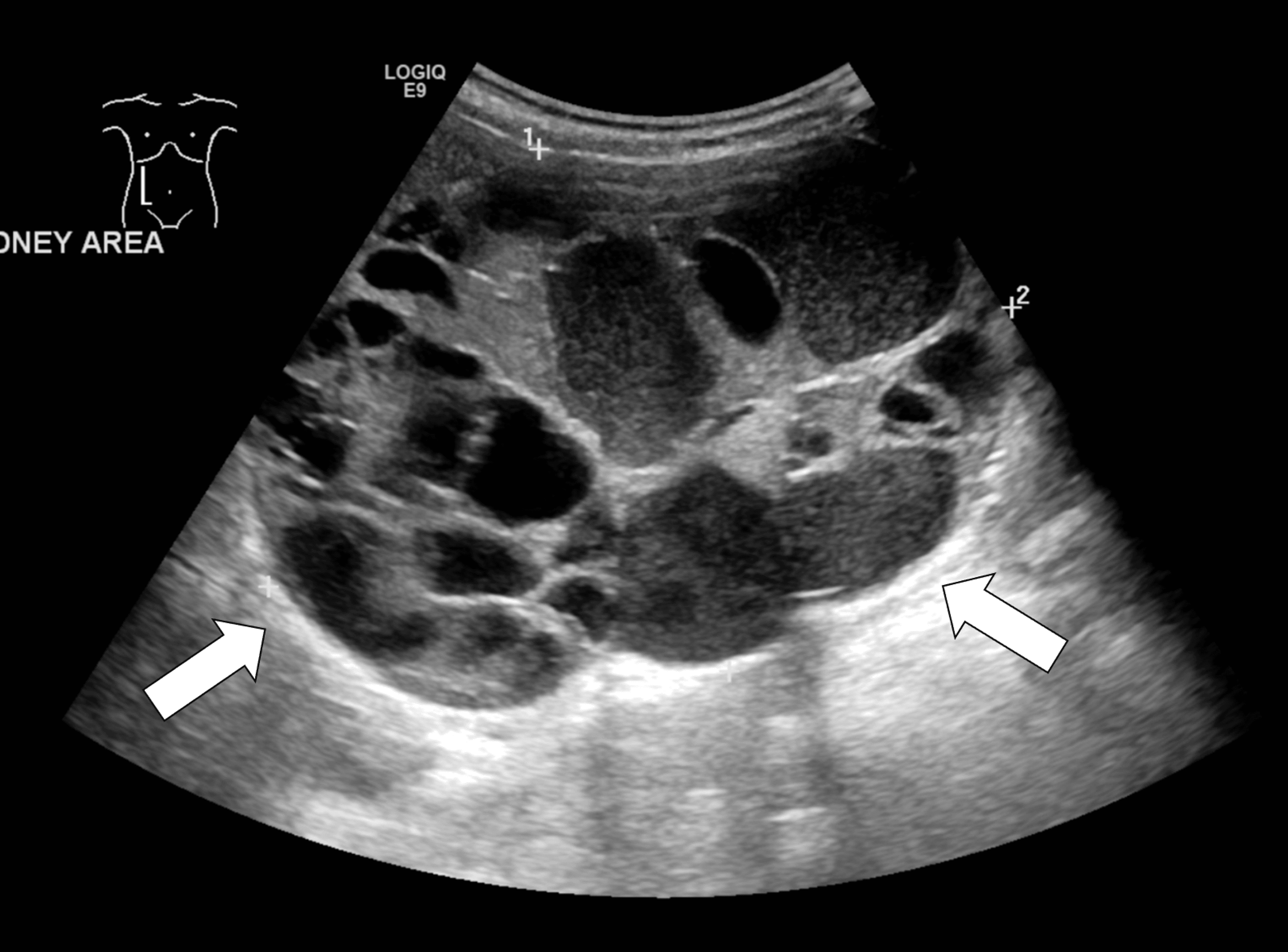 Cureus Cystic Renal Cell Carcinoma Subtype In Pediatric Patient A