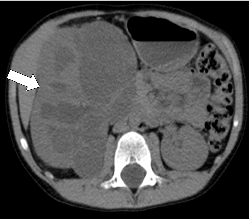 Axial-non-enhanced-CT-scan-showing-multiloculated-well-defined-soft-tissue-lesion-arising-from-the-right-kidney-measuring-11x8x7.5-cm-(arrow)