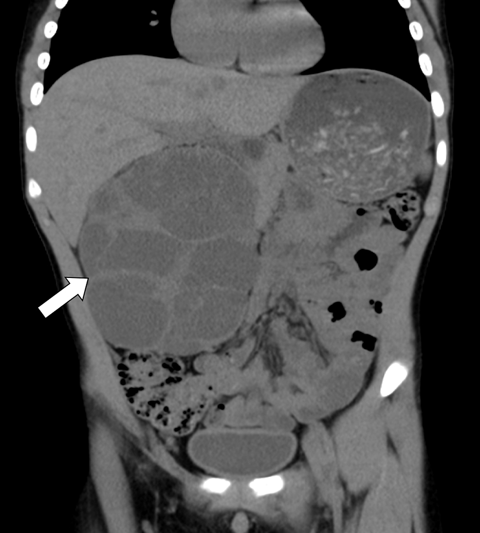Coronal-non-enhanced-CT-image-showing-clearly-the-multicystic-nature-of-the-large-right-kidney-mass-(arrow)