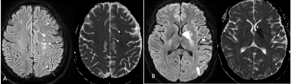 Diffusion-weighted-imaging-demonstrating-left-basal-ganglia-and-left-hemispheric-watershed-infarcts