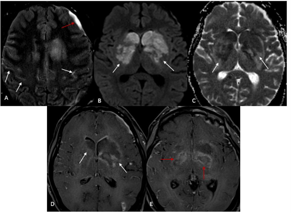 Intracranial-extension-of-the-mucormycosis