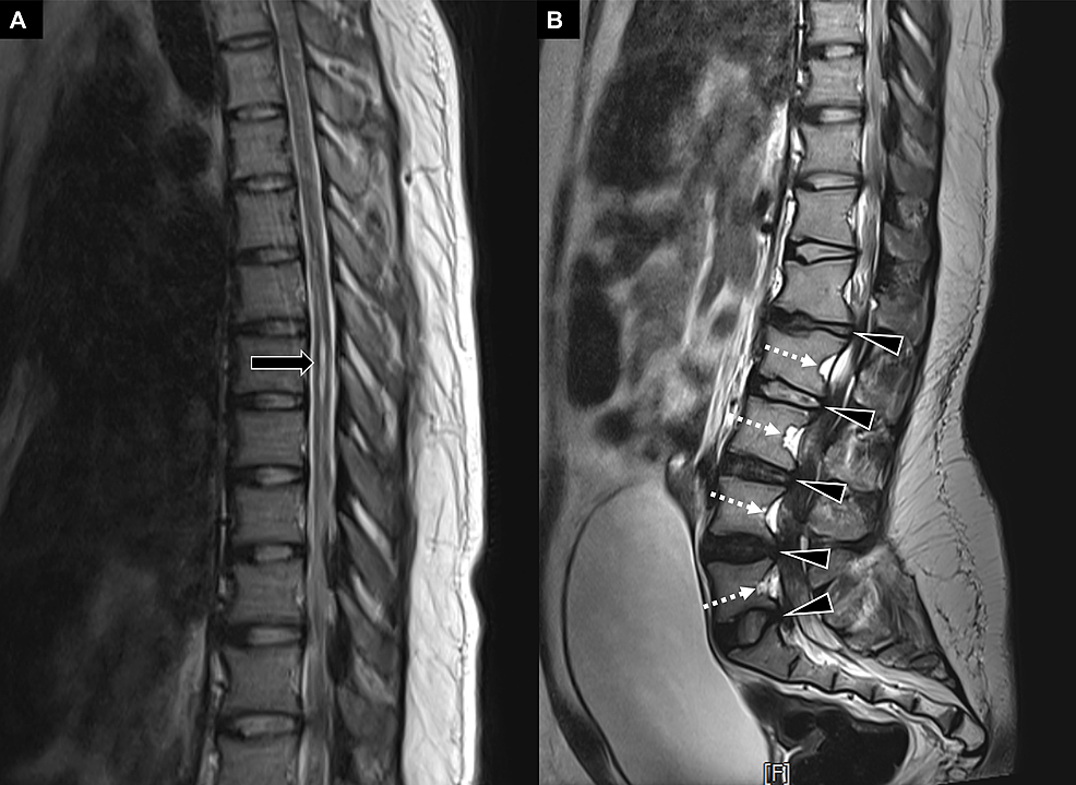Lower Back Pain Heralding Cauda Equina Syndrome in a Patient With Achondroplasia