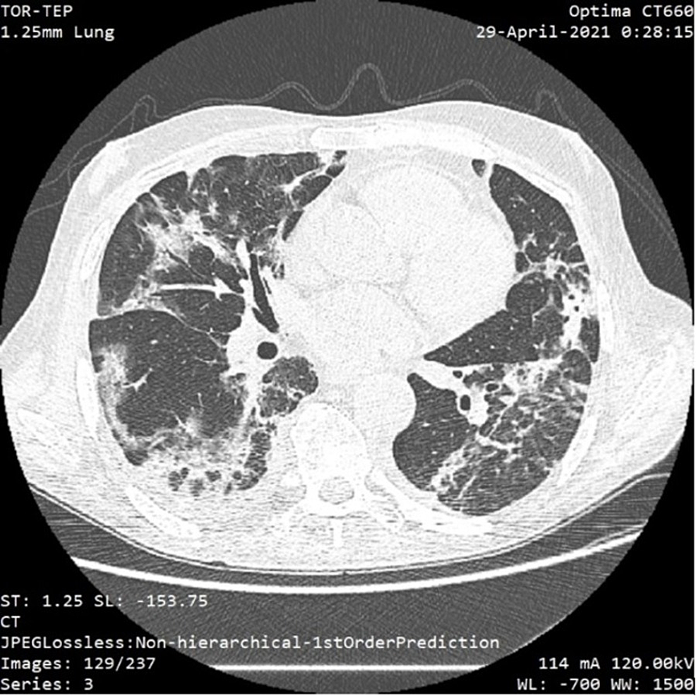 CT-scan-showing-minimal-bilateral-pleural-effusions-and-typical-glass-opacities-and-fibrosis-in-approximately-35%-of-the-lung-parenchyma