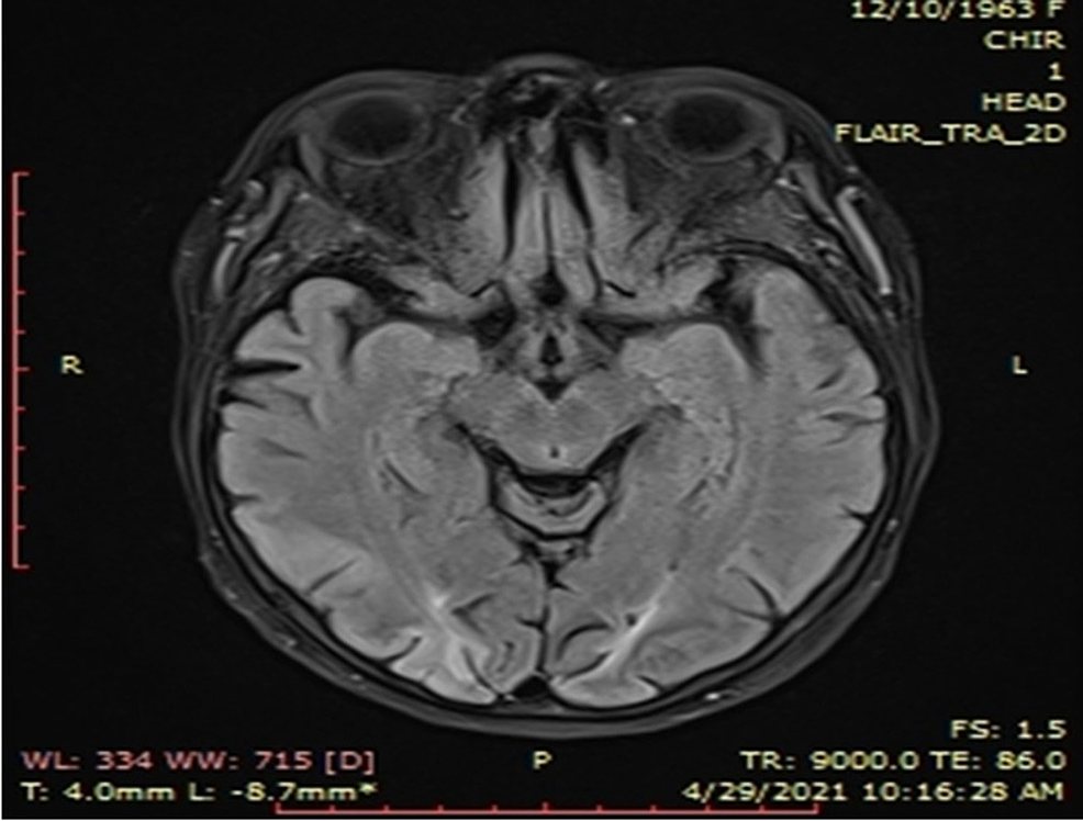Head-MRI-scan-showing-bilateral-parieto-occipito-frontal-subacute-cortical-ischemia