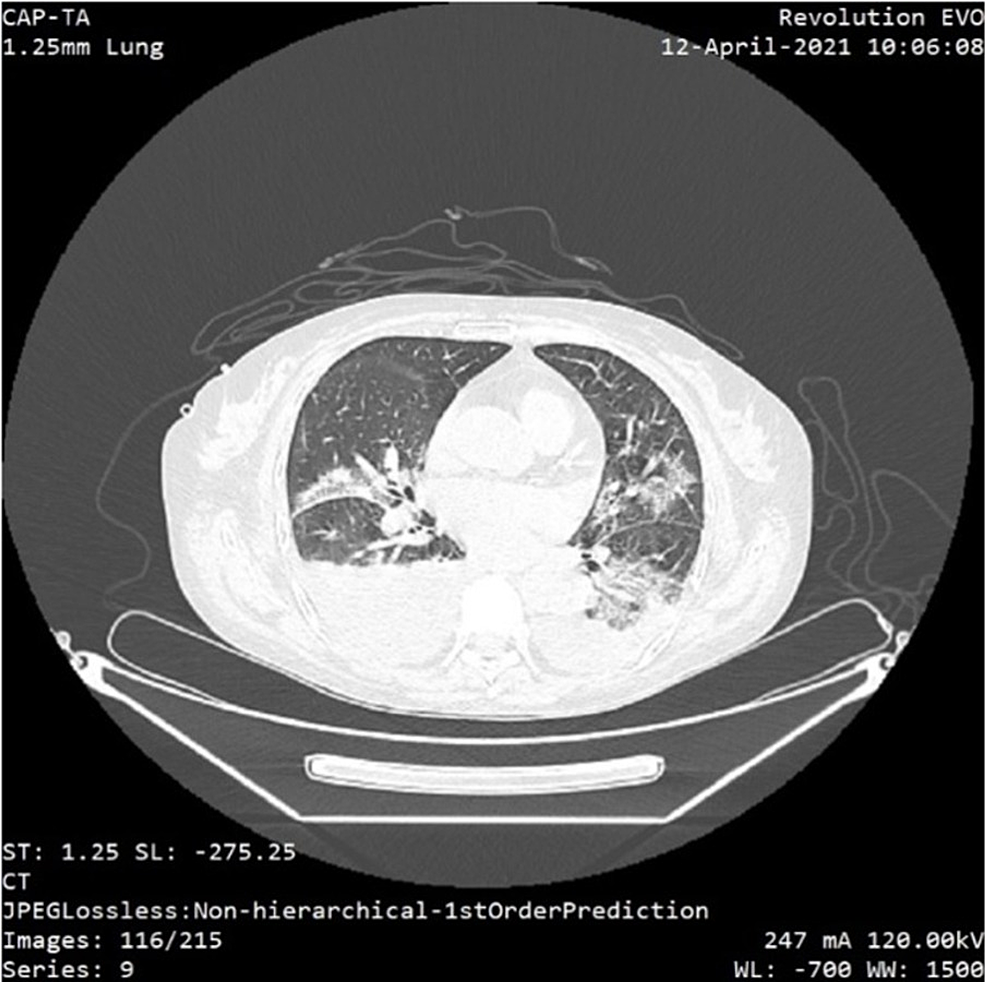 Thorax-CT-scan-revealing-moderate-bilateral-pleural-effusions-and-typical-glass-opacities,-peripheral-distributed-in-approximately-50%-of-the-lung-parenchyma