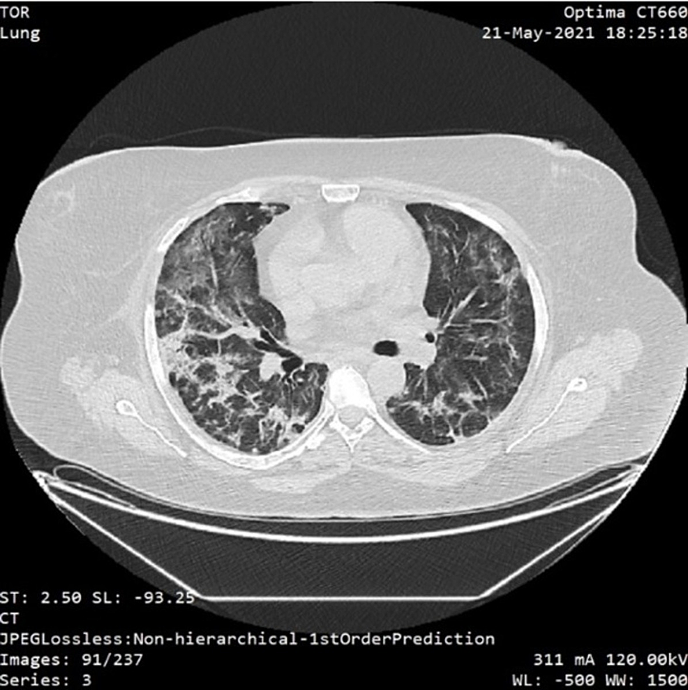 Thorax-CT-scan-showing-typical-fibrotic-lesions-associated-with-bronchiectasis-extensive-distributed-to-the-right-lung-and-2/3-of-the-left-lung-(over-75%-lung-involvement)