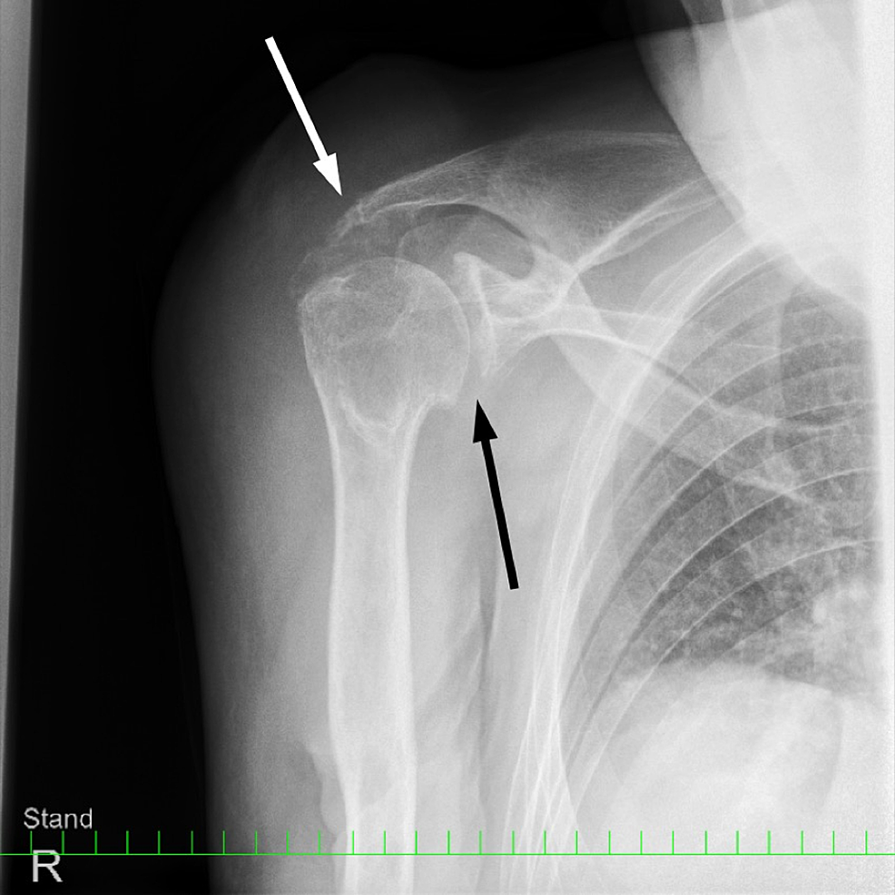 Cureus | Co-occurring Acromioclavicular Joint Cyst and Hemarthrosis of ...