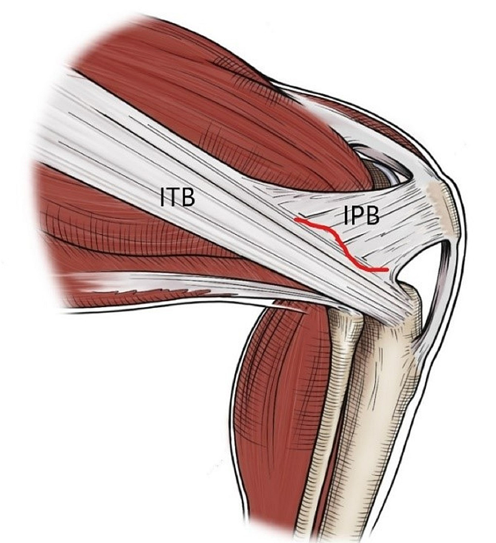 Cureus Selective Iliotibial Band Release for Iliotibial Band Traction