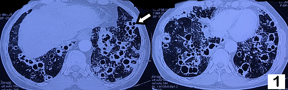 High-resolution-CT-of-thorax-showing-multiple-thin-walled,-variable-sized,-lower-lobe-predominant-air-containing-spaces.-Arrow-indicates-air-filled-cysts-in-the-lung-parenchyma.-Accompanying-the-cysts,-are-randomly-distributed-nodules.