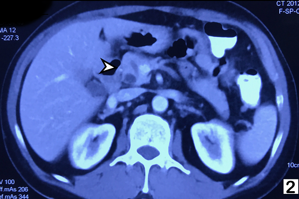 Contrast-enhanced-CT-of-abdomen-showing-enlarged-head-of-pancreas-(indicated-by-the-arrow)-with-dilated-main-pancreatic-duct.