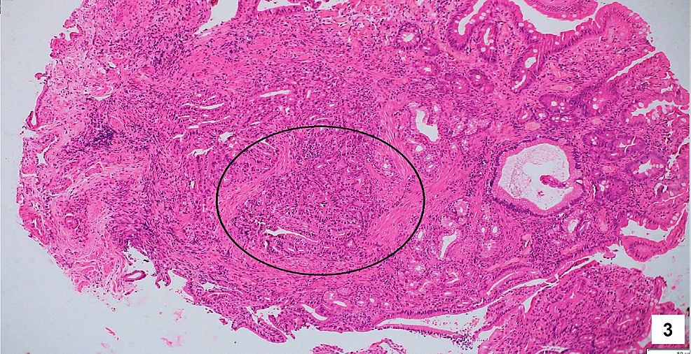 Hematoxylin-and-eosin-staining-of-the-biopsy-tissue-obtained-from-the-bulky-and-friable-papillae-showing-microscopic-foci-of-atypical-cells-with-glandular-formation,-detachment-from-the-lining-epithelium,-and-occasional-mitosis.