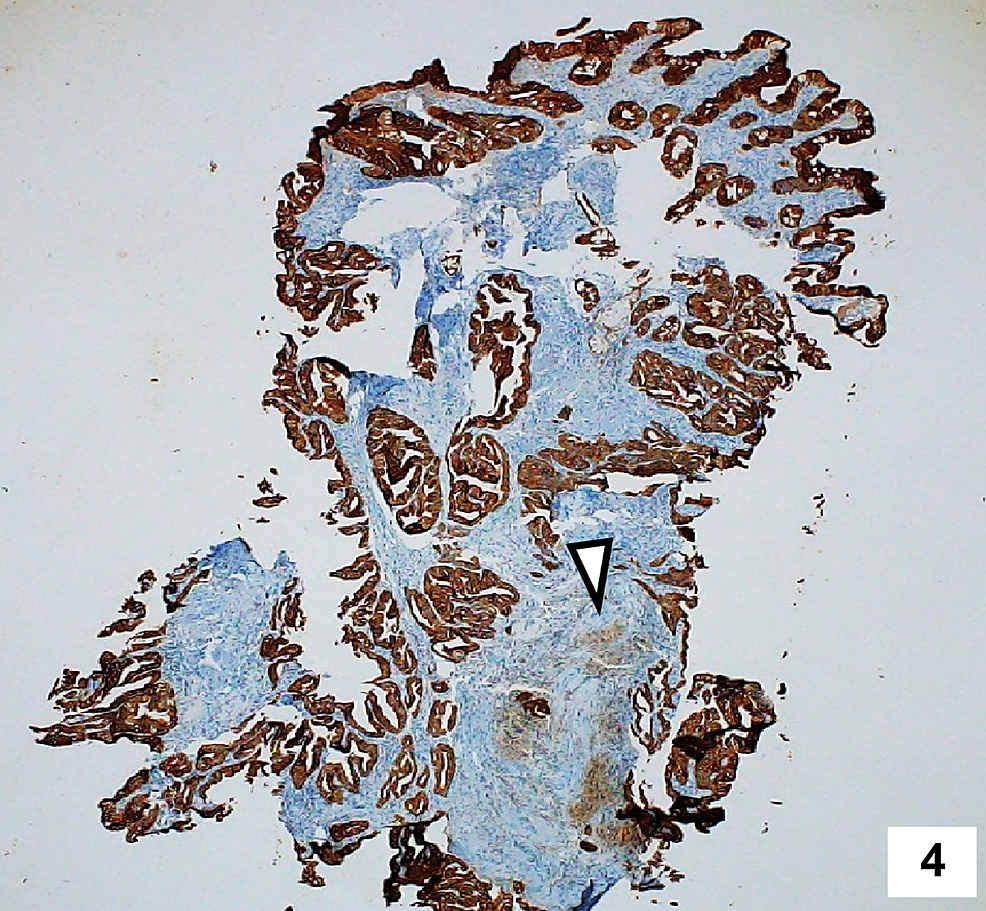 Immunohistochemistry-of-the-biopsy-specimen-showing-diffuse-positivity-for-CK-7-suggesting-pancreatic-ductal-adenocarcinoma.