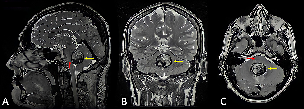 Pica, Radiology Reference Article