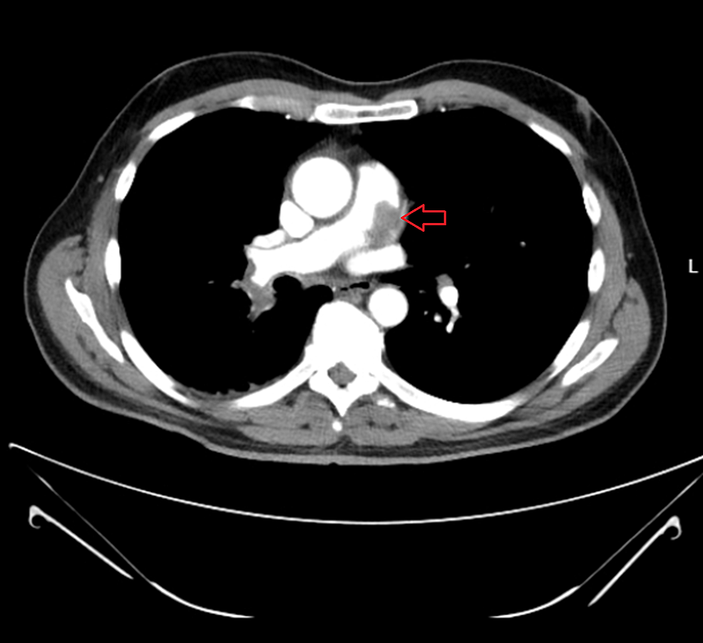 Cureus | Pulmonary Artery Root Replacement for Leiomyosarcoma: A Viable ...