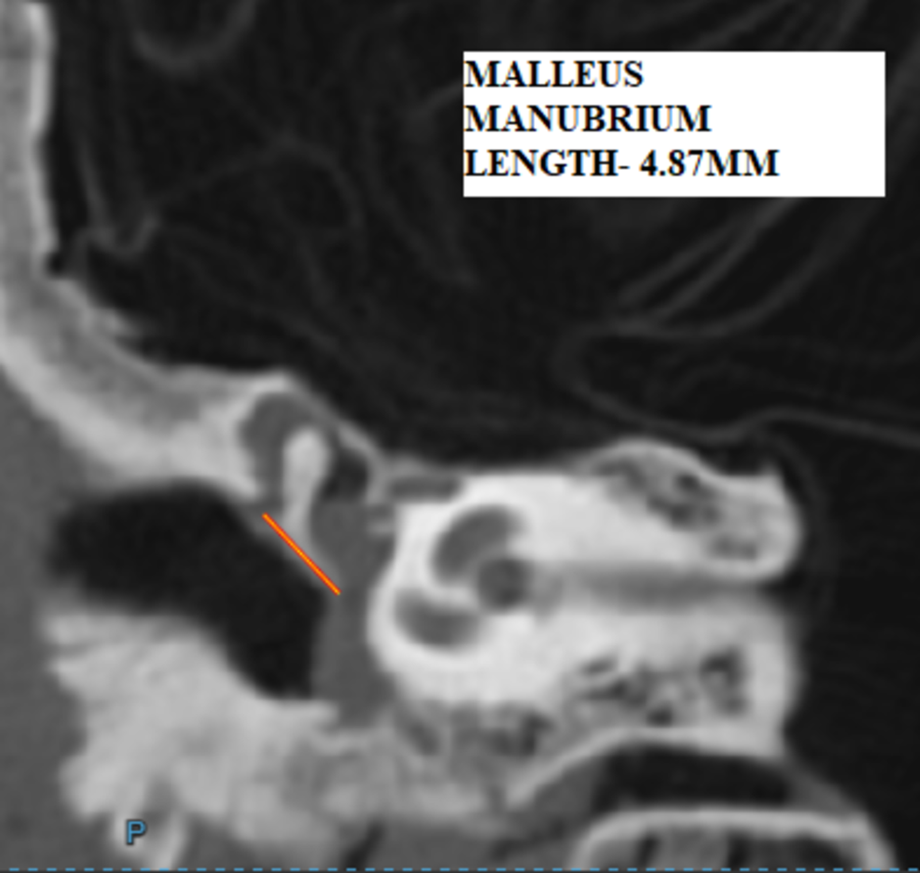 Cureus Validated Ossicular Measurements On High Resolution Computed Tomography Ct In Live And Cadaveric Temporal Bones