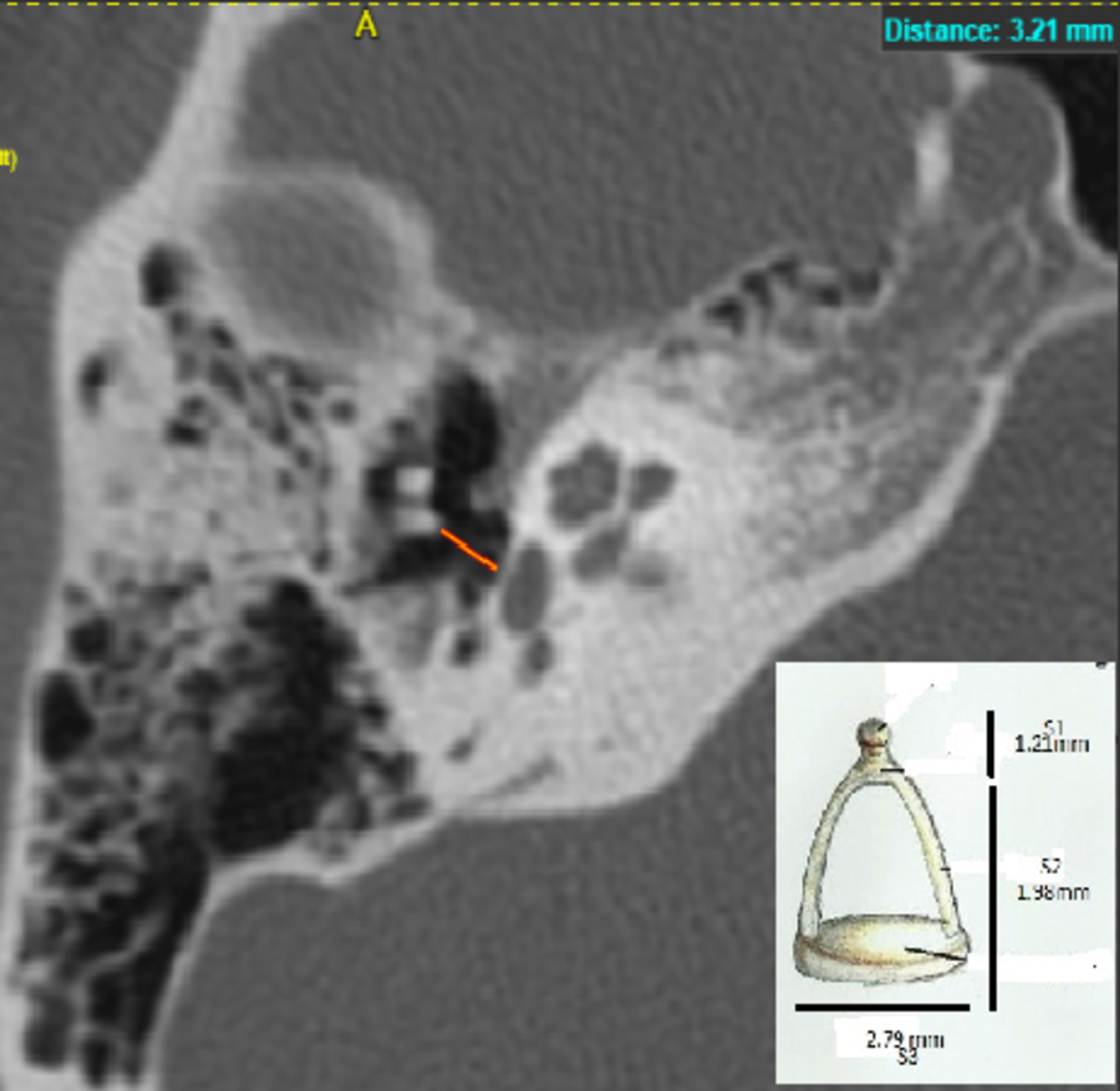 Cureus Validated Ossicular Measurements on HighResolution Computed