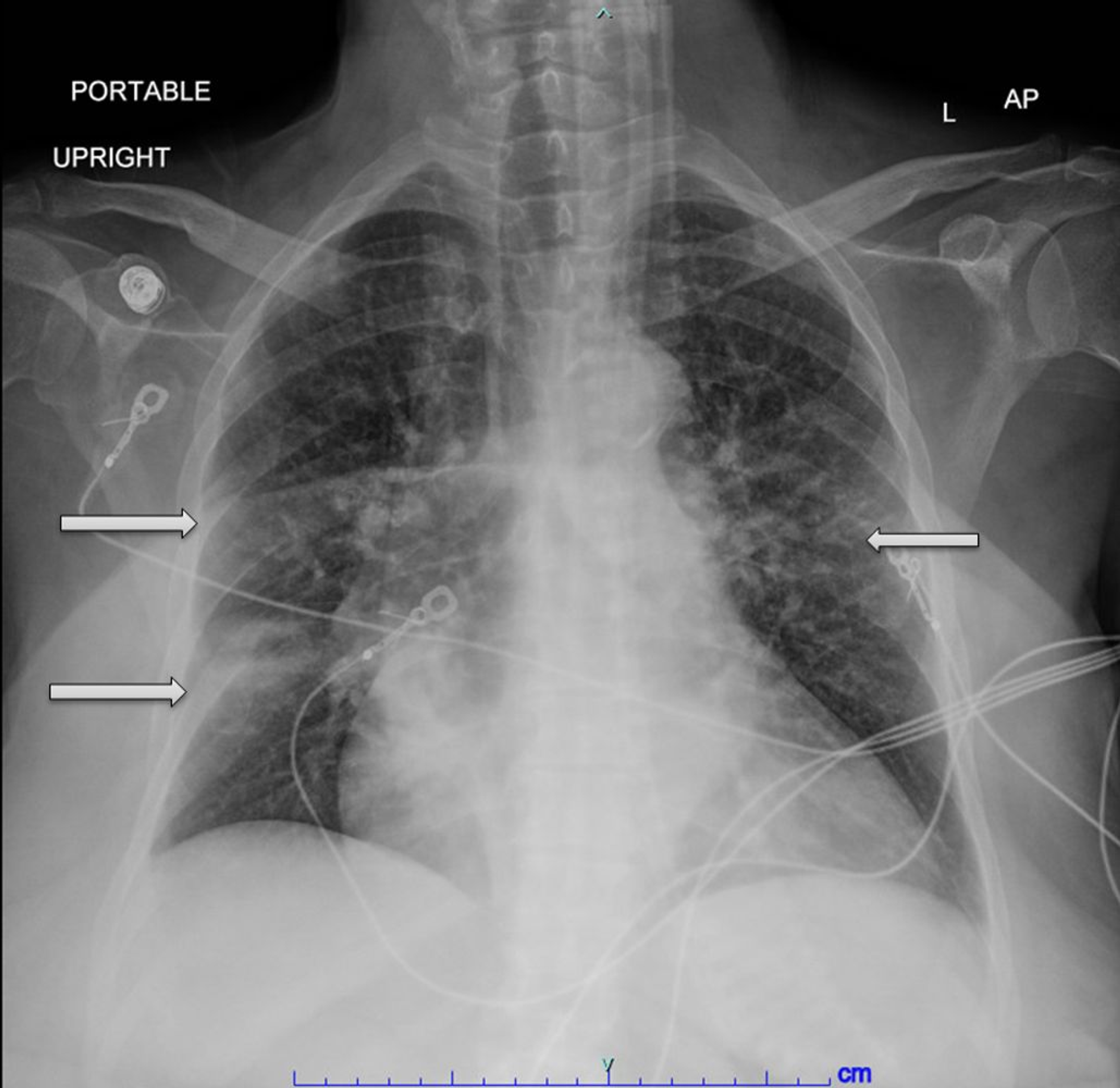 Cureus Sepsis Due to Haemophilus influenzae and Masked Influenza A