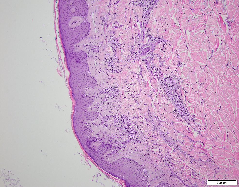 Low-power-examination-of-a-4-mm-punch-biopsy-from-the-patient's-back-shows-a-superficial-perivascular-inflammatory-infiltrate-composed-of-lymphocytes,-neutrophils,-and-occasional-eosinophils-with-abundant-karyorrhectic-debris-and-extravasated-erythrocytes