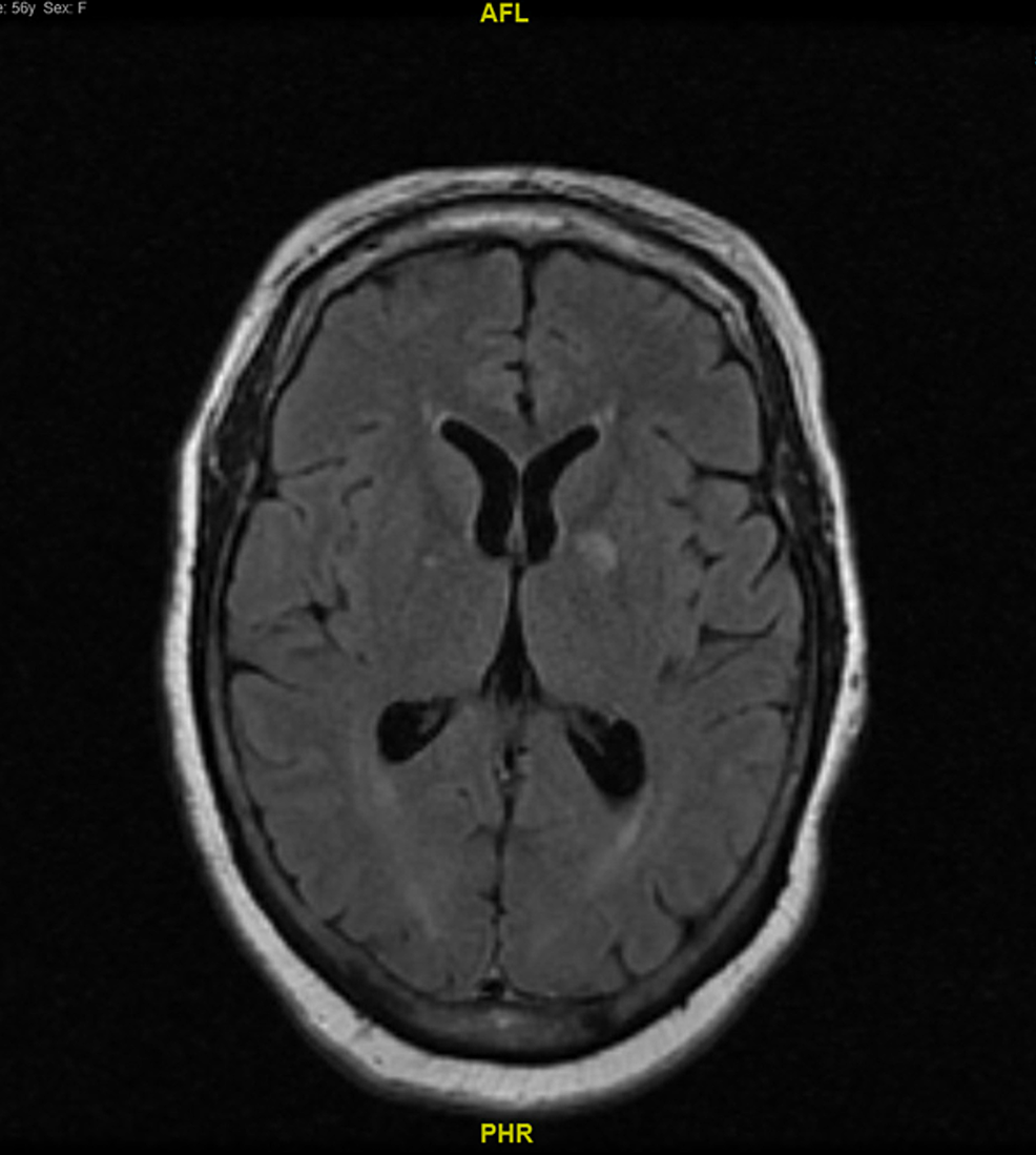 cureus-a-case-of-cerebellar-hippocampal-and-basal-nuclei-transient