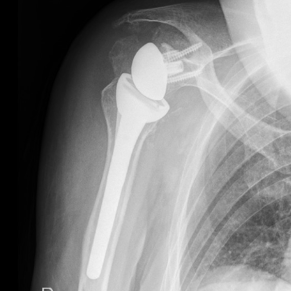 Cureus | Co-occurring Acromioclavicular Joint Cyst and Hemarthrosis of ...