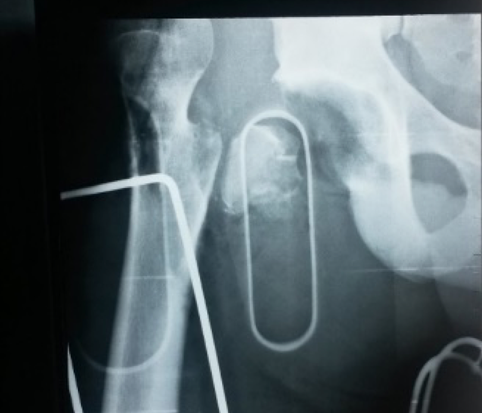 A-radiograph-of-the-right-hip-showing-the-dislocation-with-a-fracture-of-the-greater-trochanter